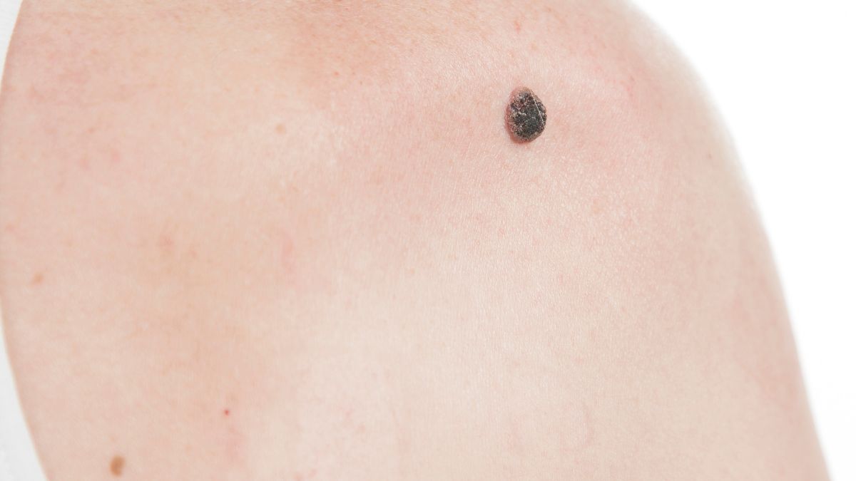 Egy bőrön található anyajegy, amely sötét színű és szabálytalan formájú.