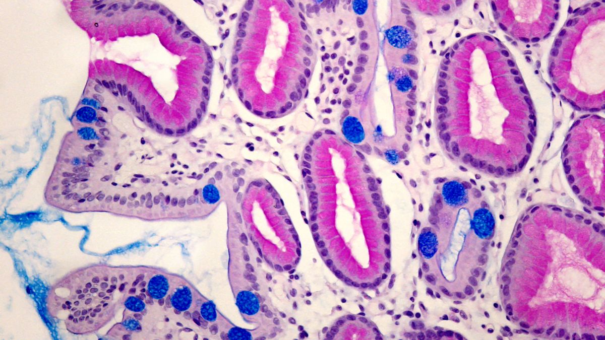 Mikroszkópos kép, amely különböző szöveti elváltozásokat mutat, a metaplasia folyamatát illusztrálva.